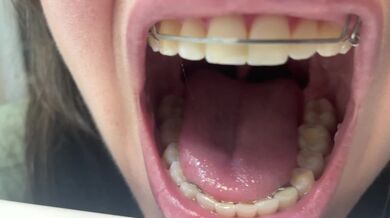 Primo piano della bocca del fermo (ANTEPRIMA)